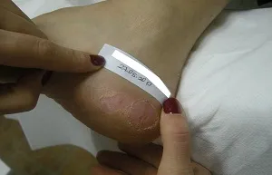 Siğil/Human Papilloma Virüsü (HPV) — Ayak Sigil Tedavisi