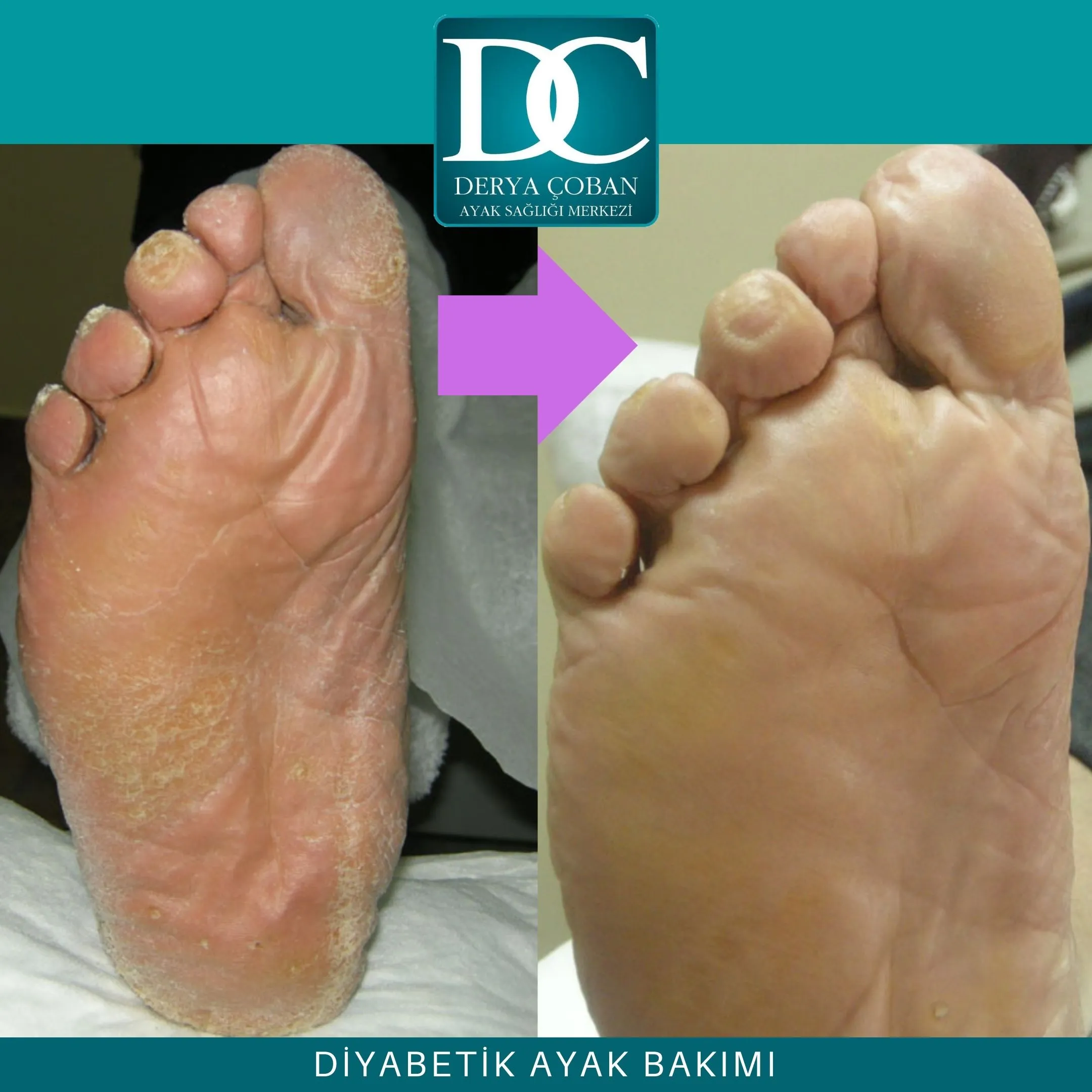 diyabetik ayak