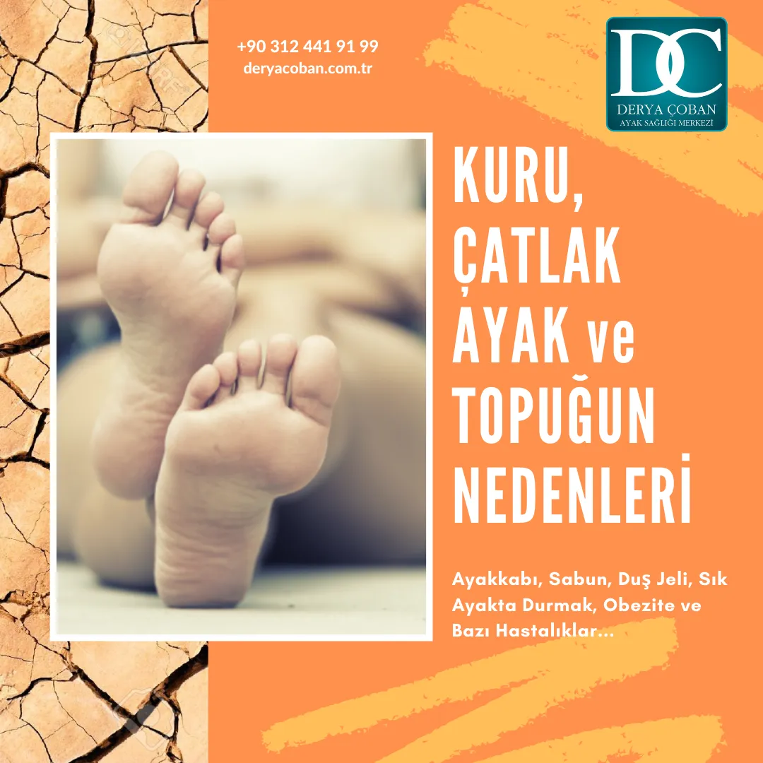 Ayak Neden Kurur? Topuk Neden Çatlar?