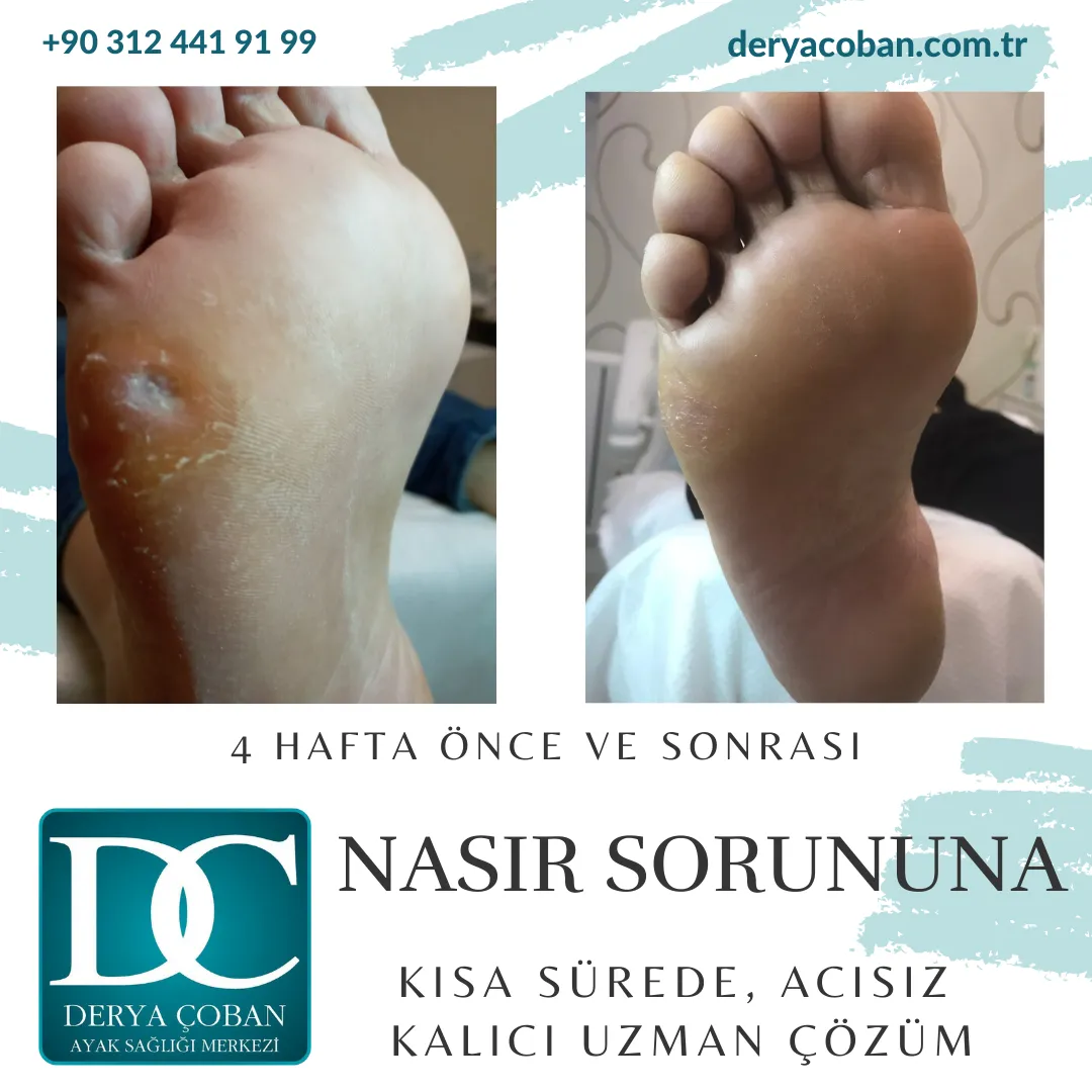 Nasır Problemi Nasıl Çözülür?