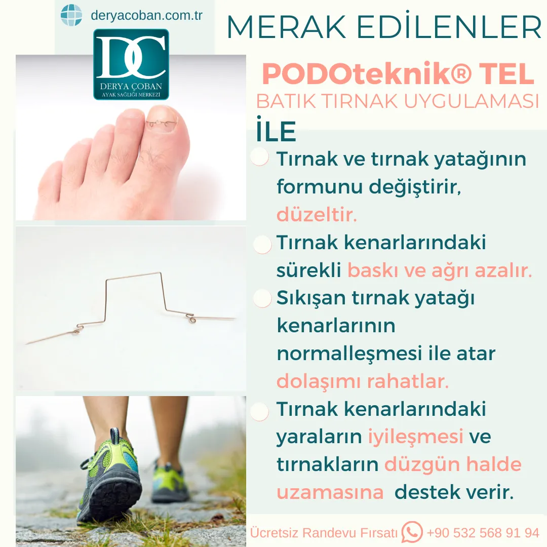 Batık Tırnak İçin Uygulanan Podoteknik® Tel Günlük...