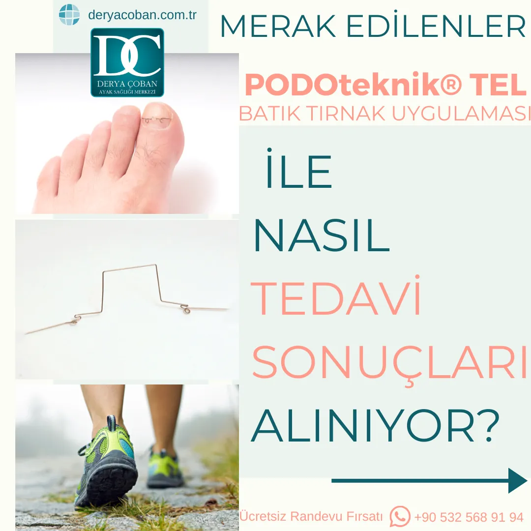 PODOteknik® Tel ile Tırnak Batması Nasıl Çözülür?