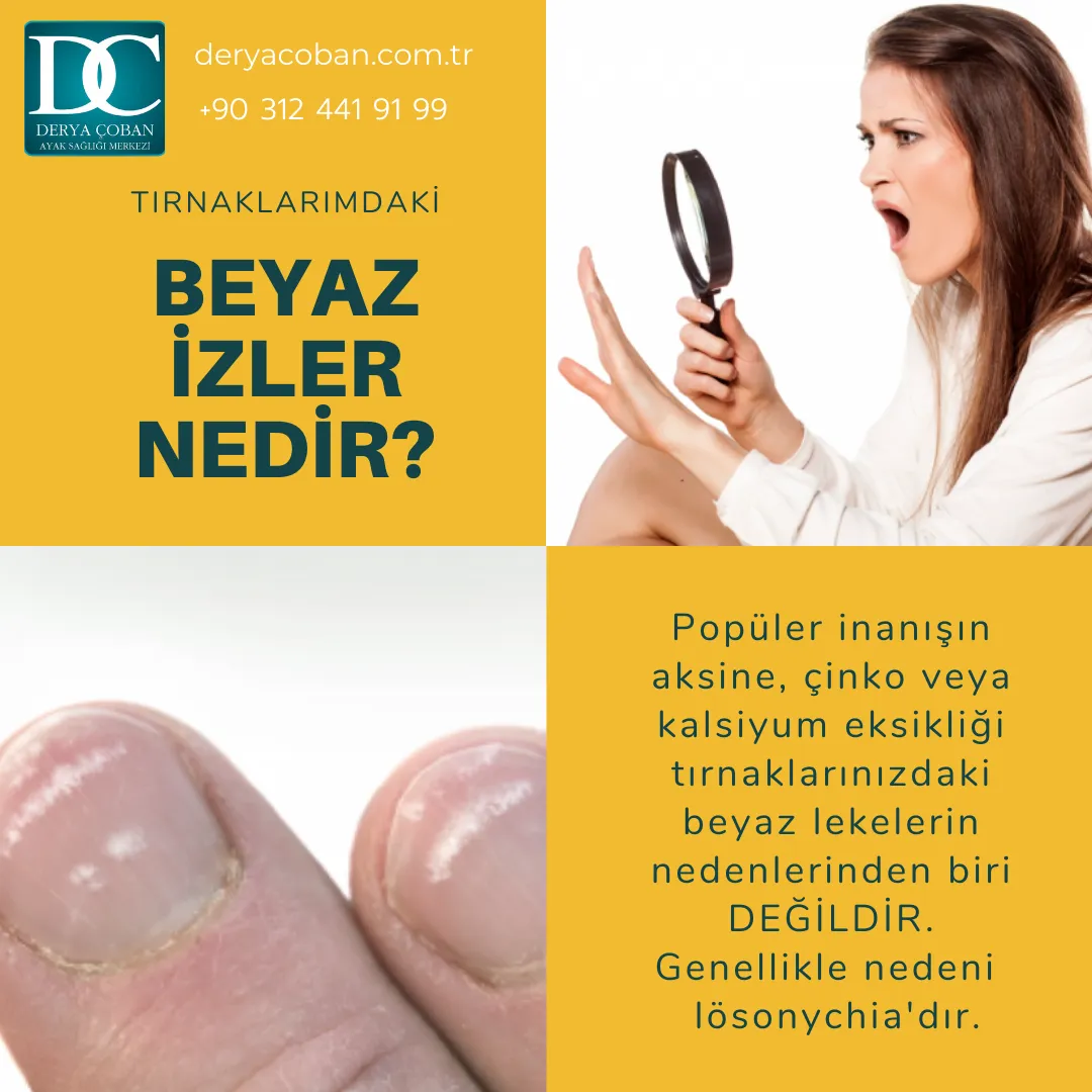 Tırnaklardaki Beyaz İzler Neden Oluşur?
