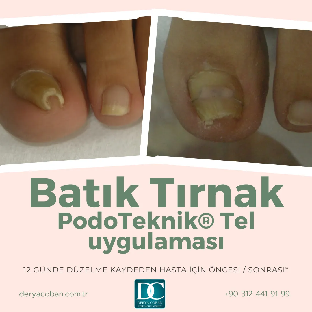 Batık Tırnak için Hızlı Kalıcı ve Ağrısız Çözüm