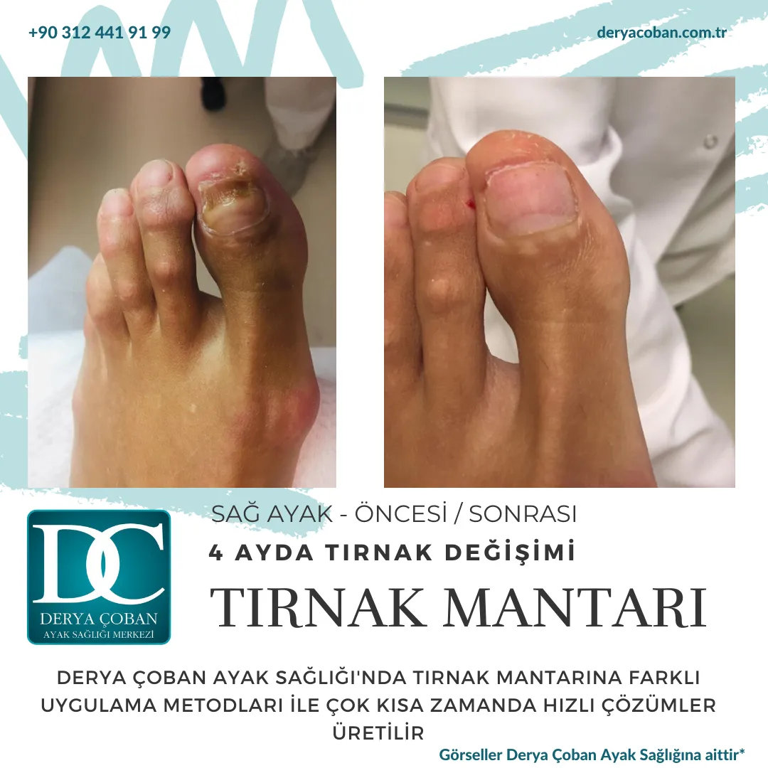 Tırnak Mantarı olduğunuzu düşünüyordunuz Hangi Doktora...