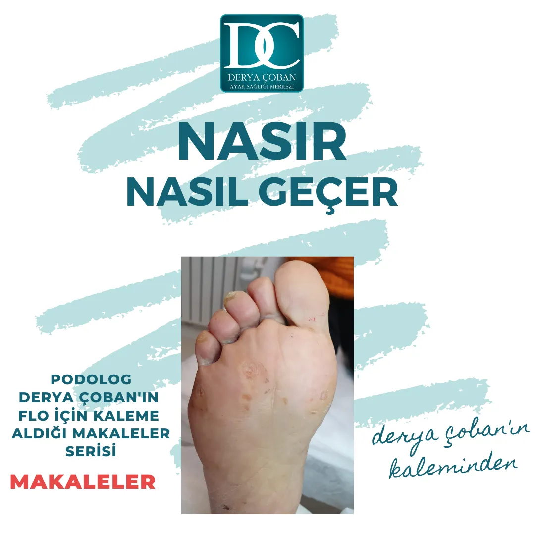 Ayakta Oluşan Nasır Nasıl Geçer?