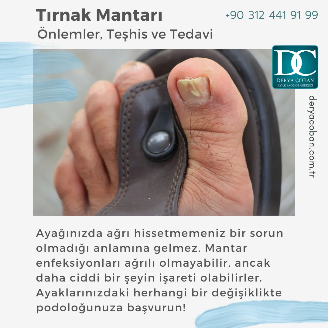 Tırnak Mantarı Nedir? Nasıl Tedavi Edilir? Nasıl Önlenir?