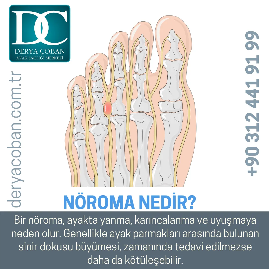 Nöroma Nedir?