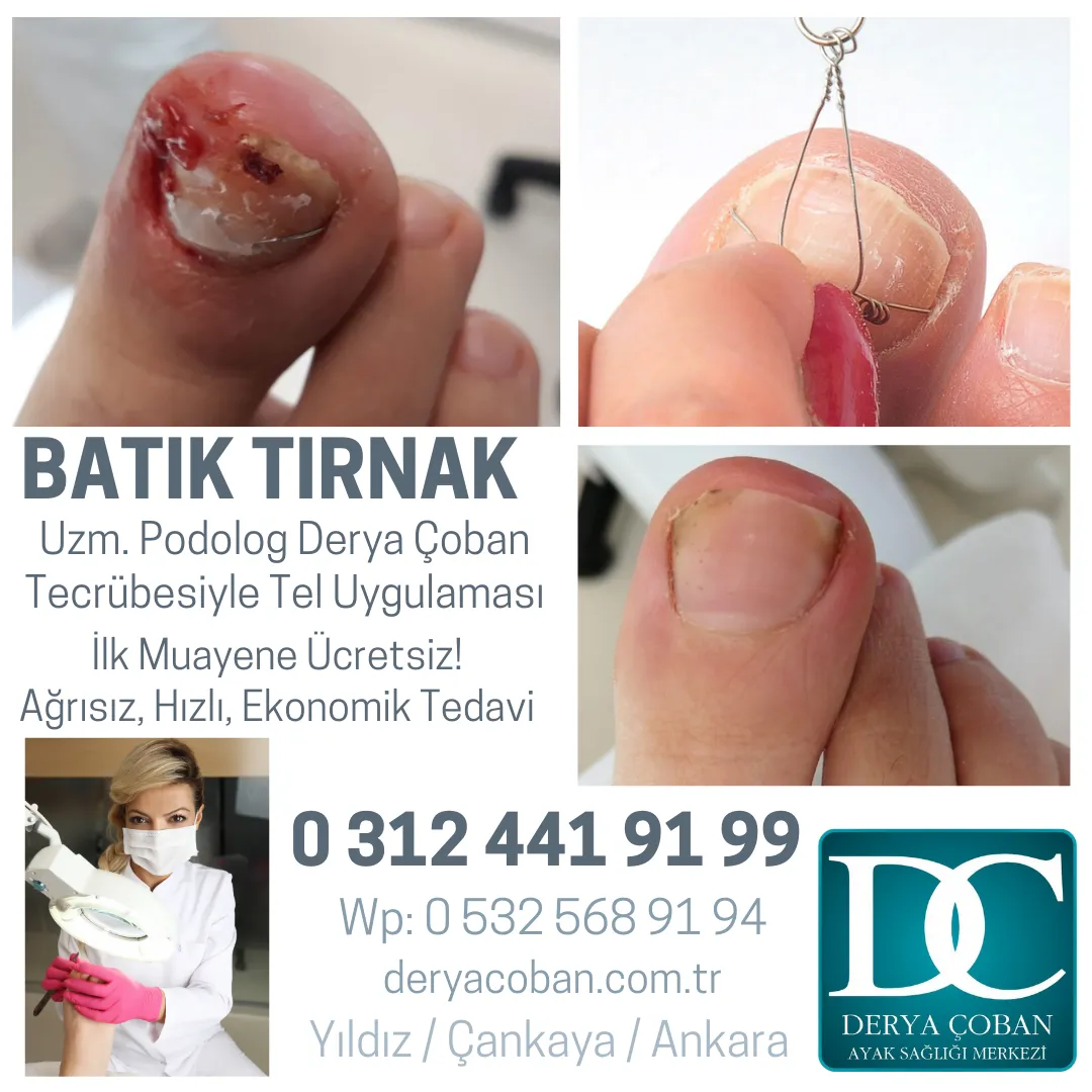 Enfeksiyonlu Batık Tırnak Nasıl Tedavi Edilir?