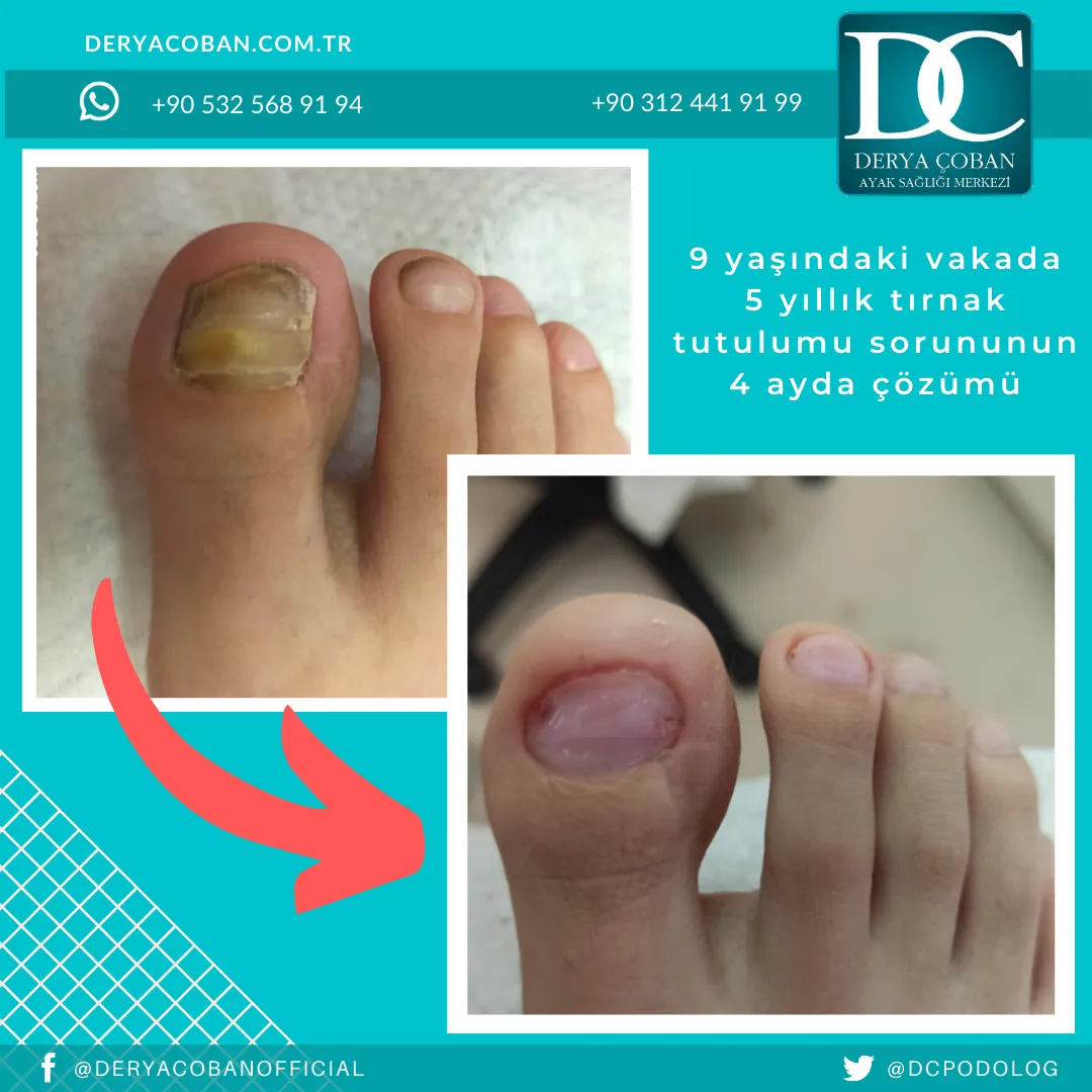 Tırnak Tutulumu Nasıl Tedavi Edilir?
