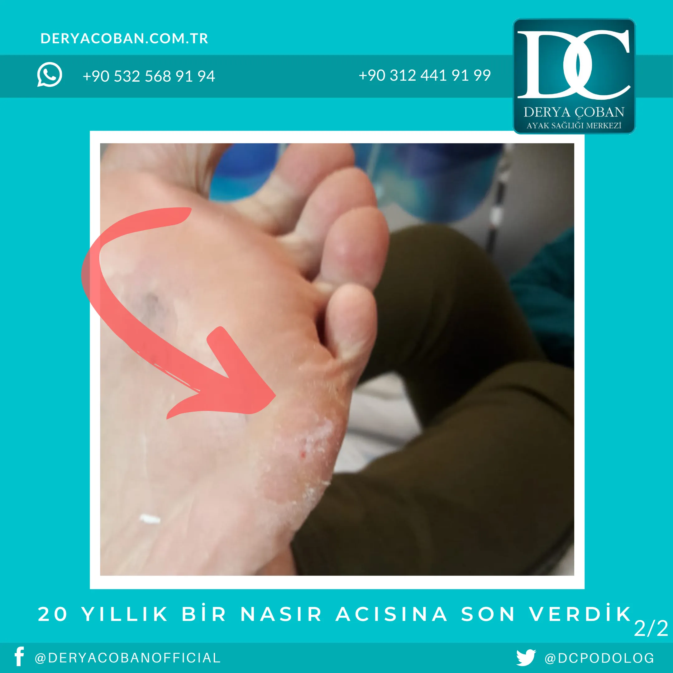 Acısız ve Kalıcı Nasır Tedavisi Nasıl Olmalı?