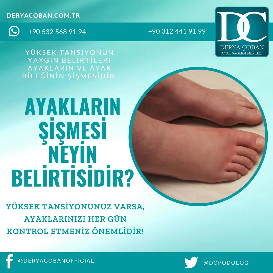 Ayak Şişmesi Neden Olur? Yüksek Kan Basıncı Nedir?