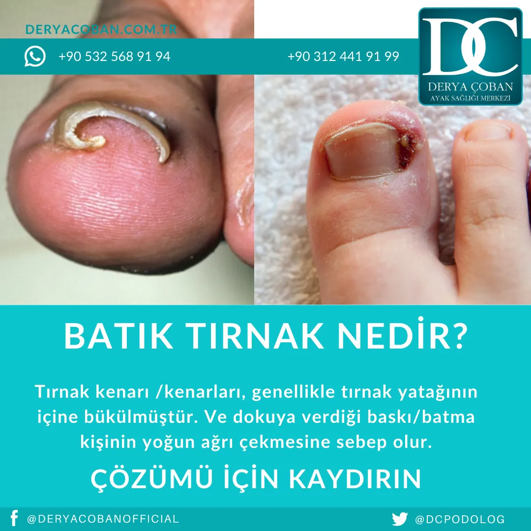 Batık Tırnak Nedir? Nasıl Çözülür?