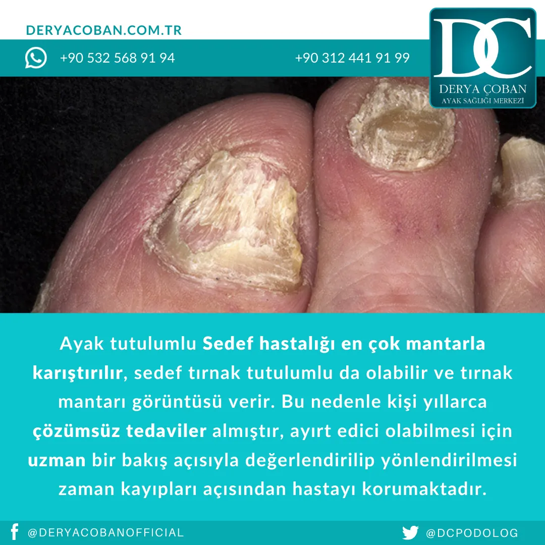 Sedef Hastalığı Nedir? Ayakta Nasıl Görülür?