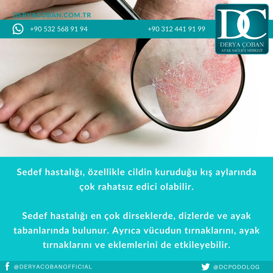 Sedef Hastalığı Nedir? Ayakta Nasıl Görülür?