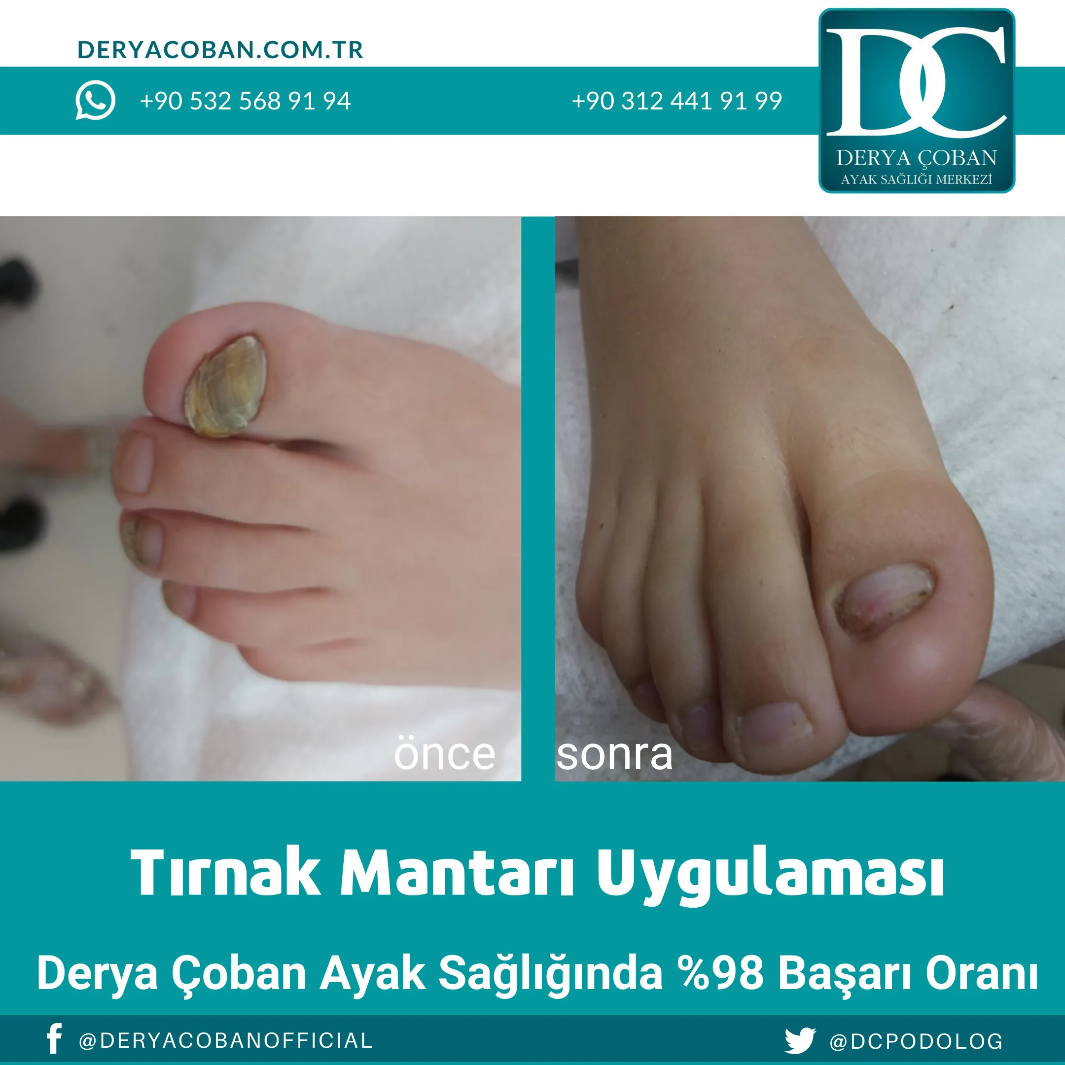 Tırnak Mantarı Tedavisi