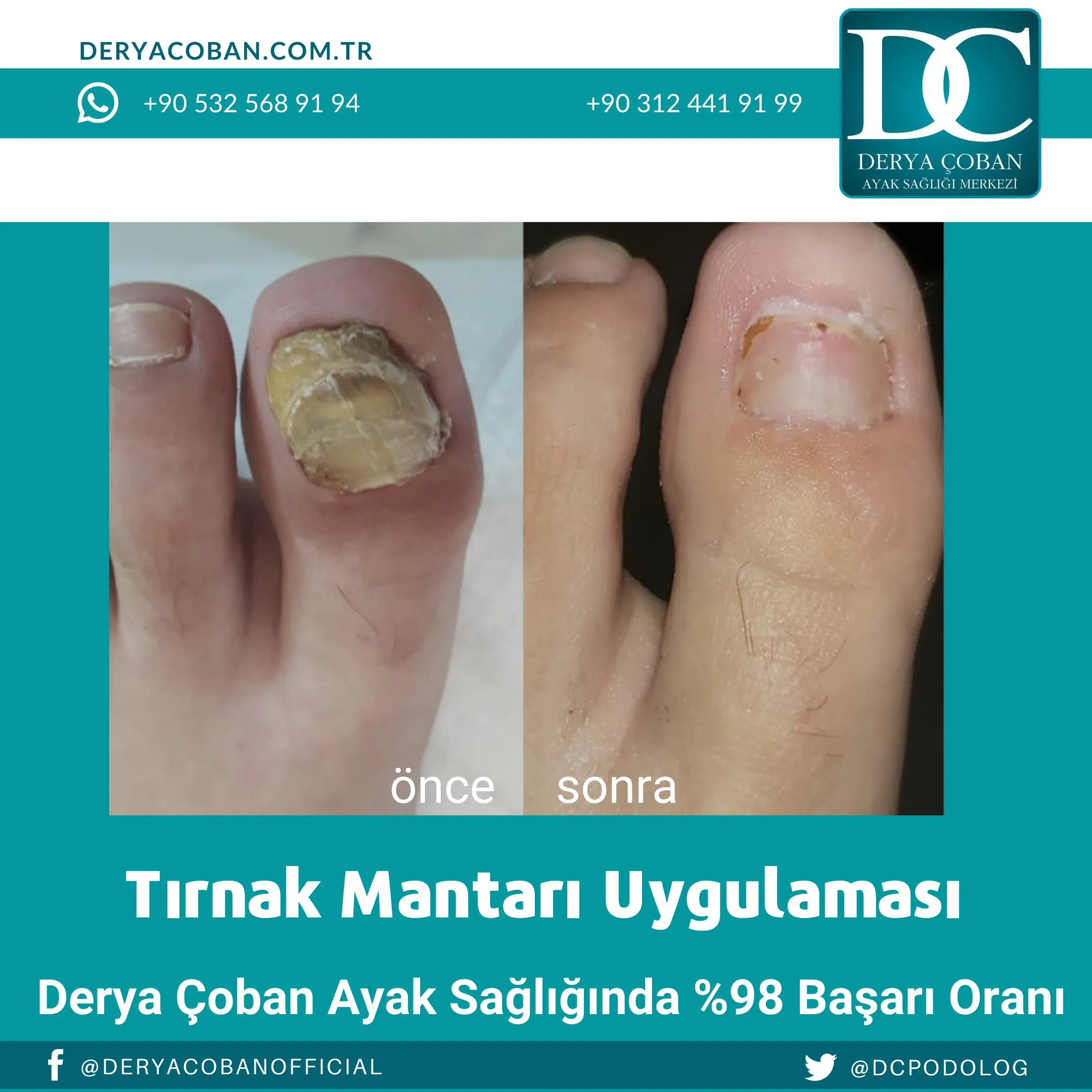 Tırnak Mantarı Tedavisi