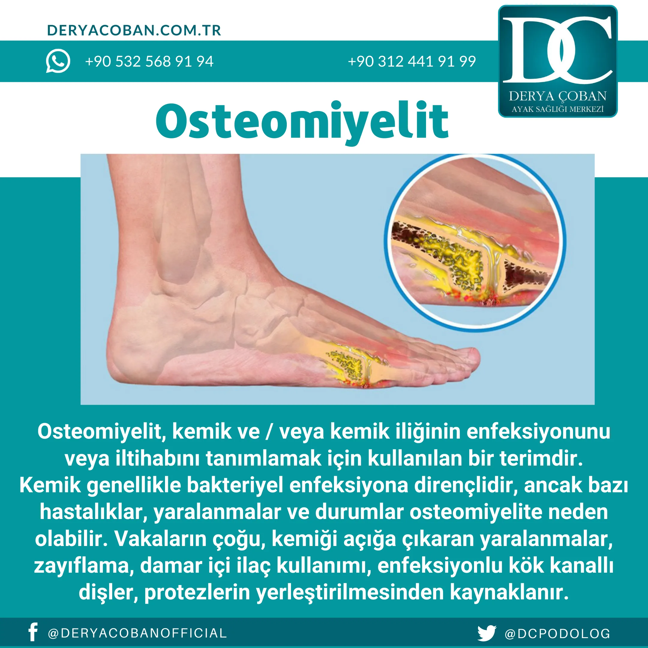 Osteomiyolit Nedir? Nasıl Tedavi Edilir?
