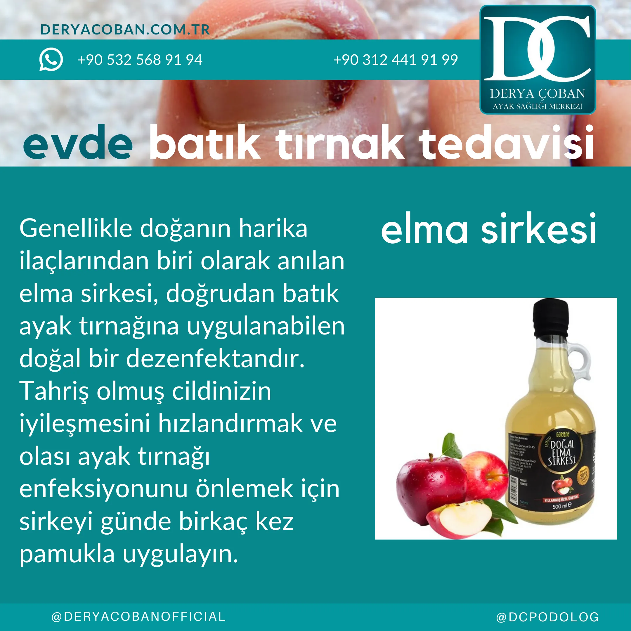 Evde Batık Tırnak Tedavisi