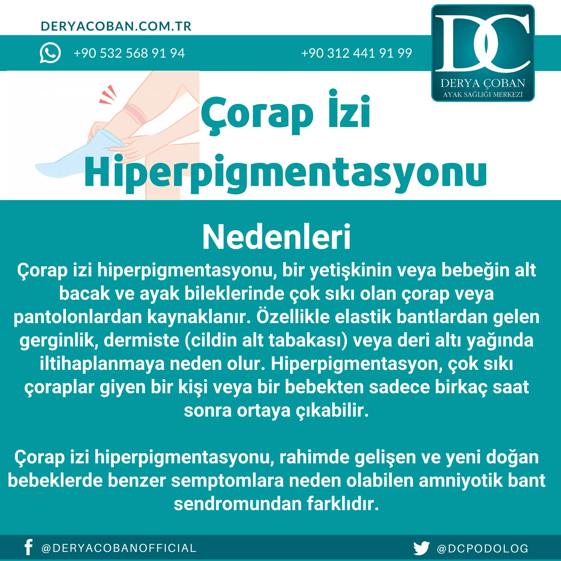 Çorap İzi Nasıl Geçer? Çorap İzi Hiperpigmentasyonu