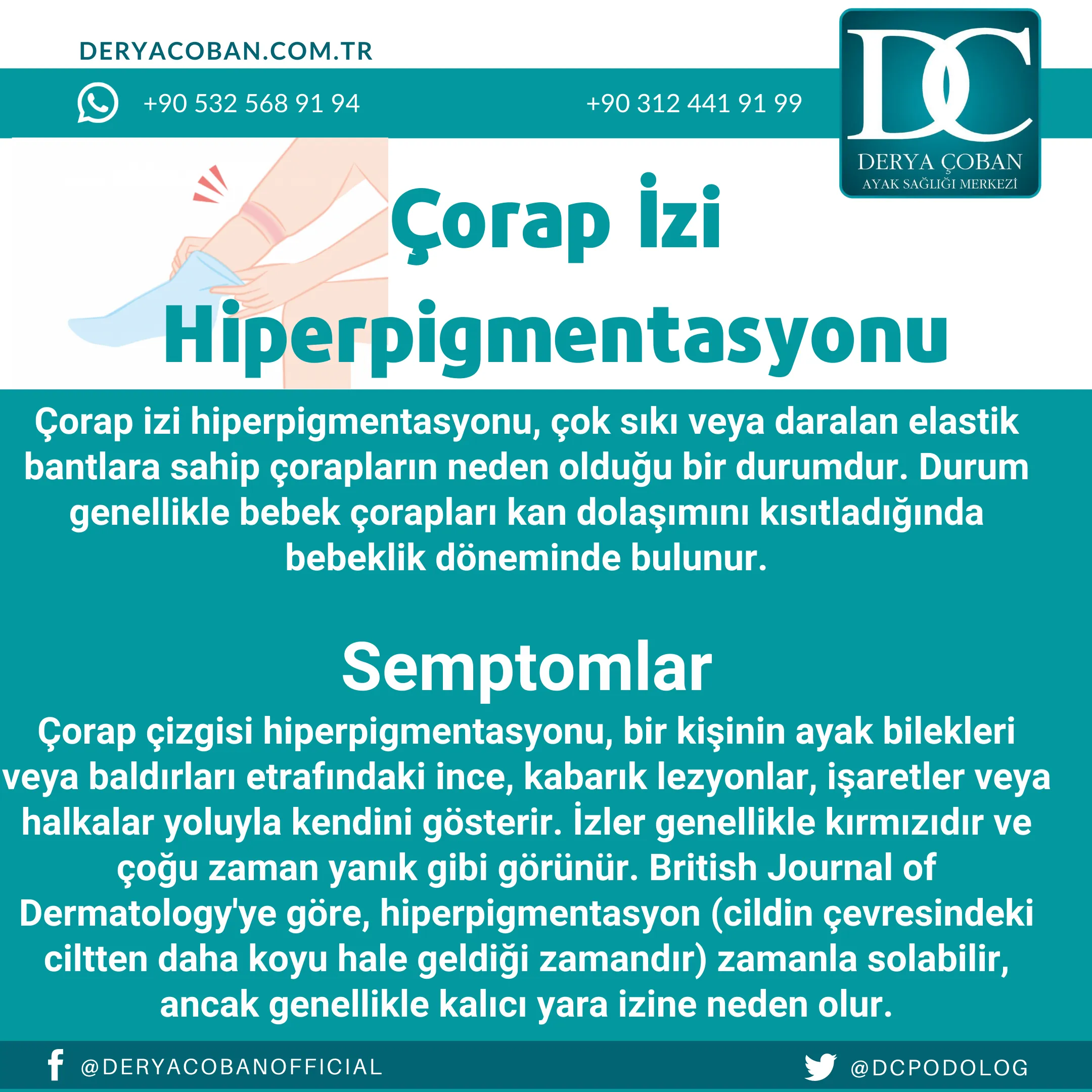 Çorap İzi Nasıl Geçer? Çorap İzi Hiperpigmentasyonu