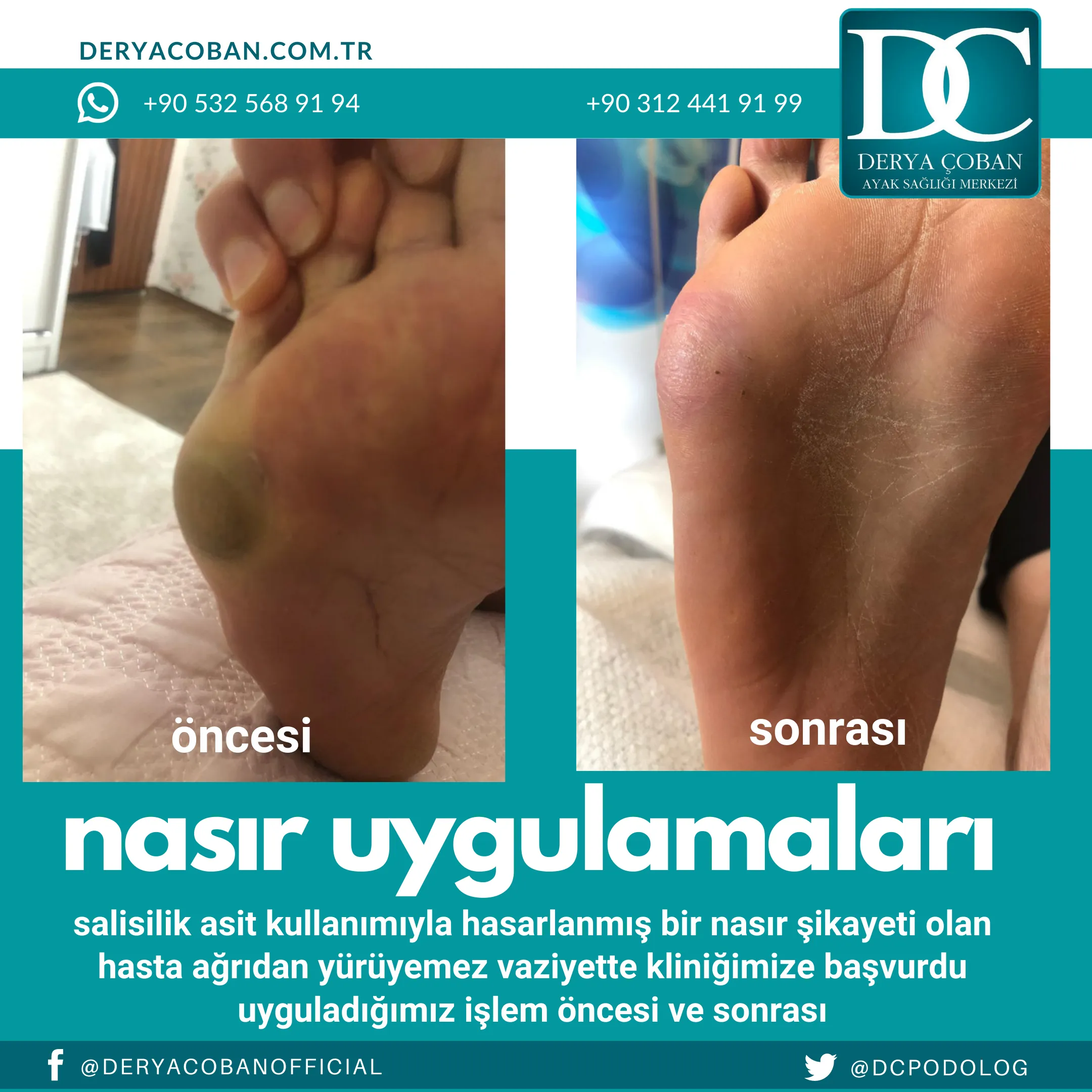 Nasır Nasıl Düzelir?