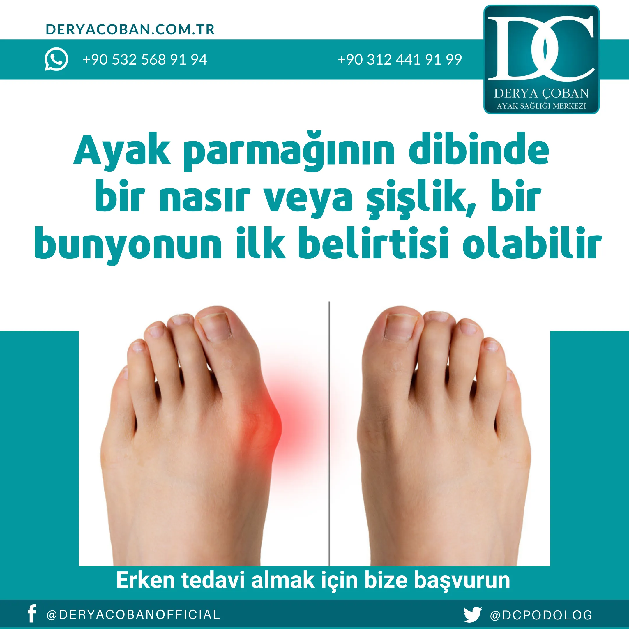 Bunyon nedir?
