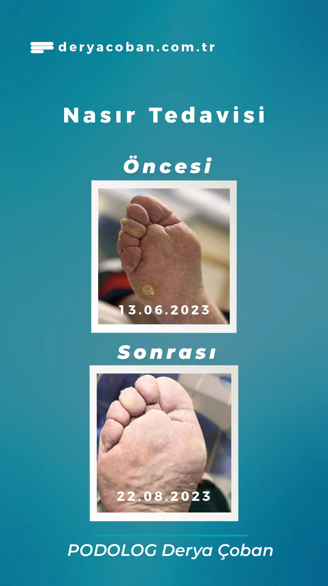 Nasır Tedavisi Öncesi Sonrası