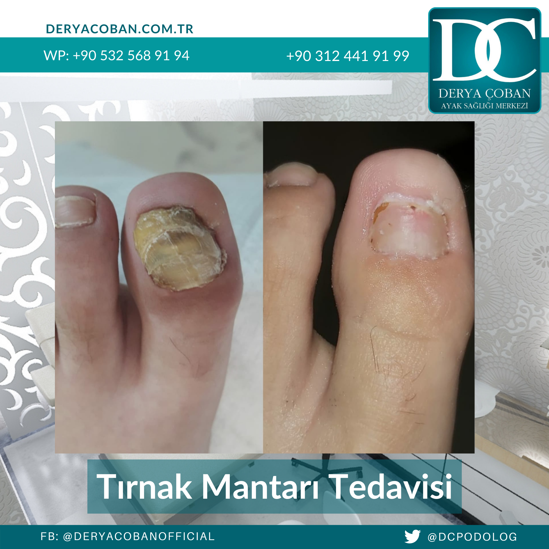ayak hastalığı tedavileri