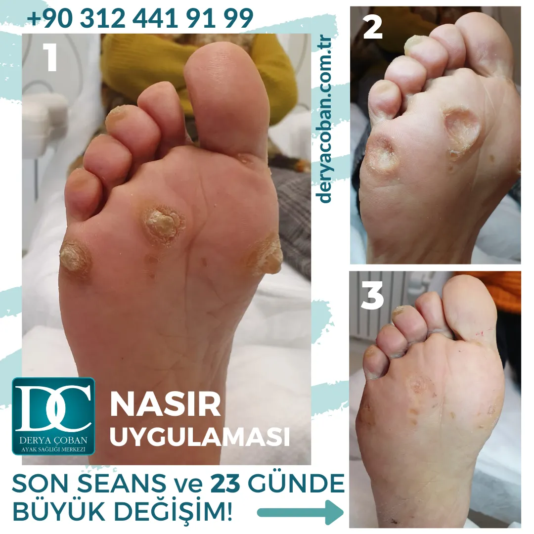 Nasır Uygulamaları Derya Çoban